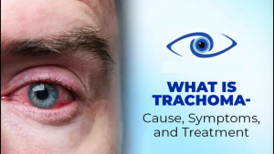 India Declared Trachoma Free 