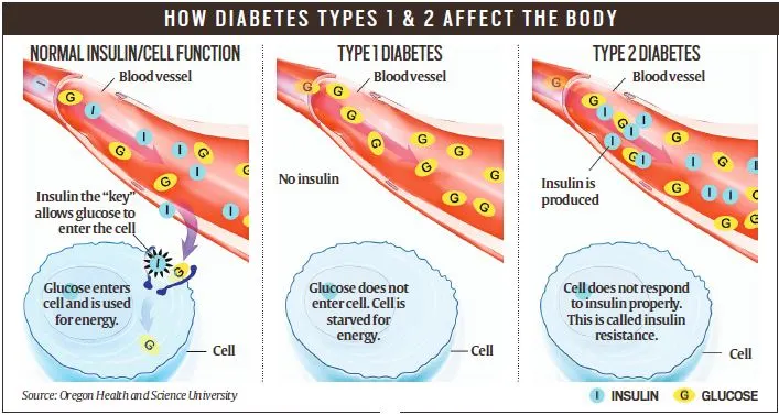 Stem Cell Therapy: A New Hope for Type 1 Diabetes in India