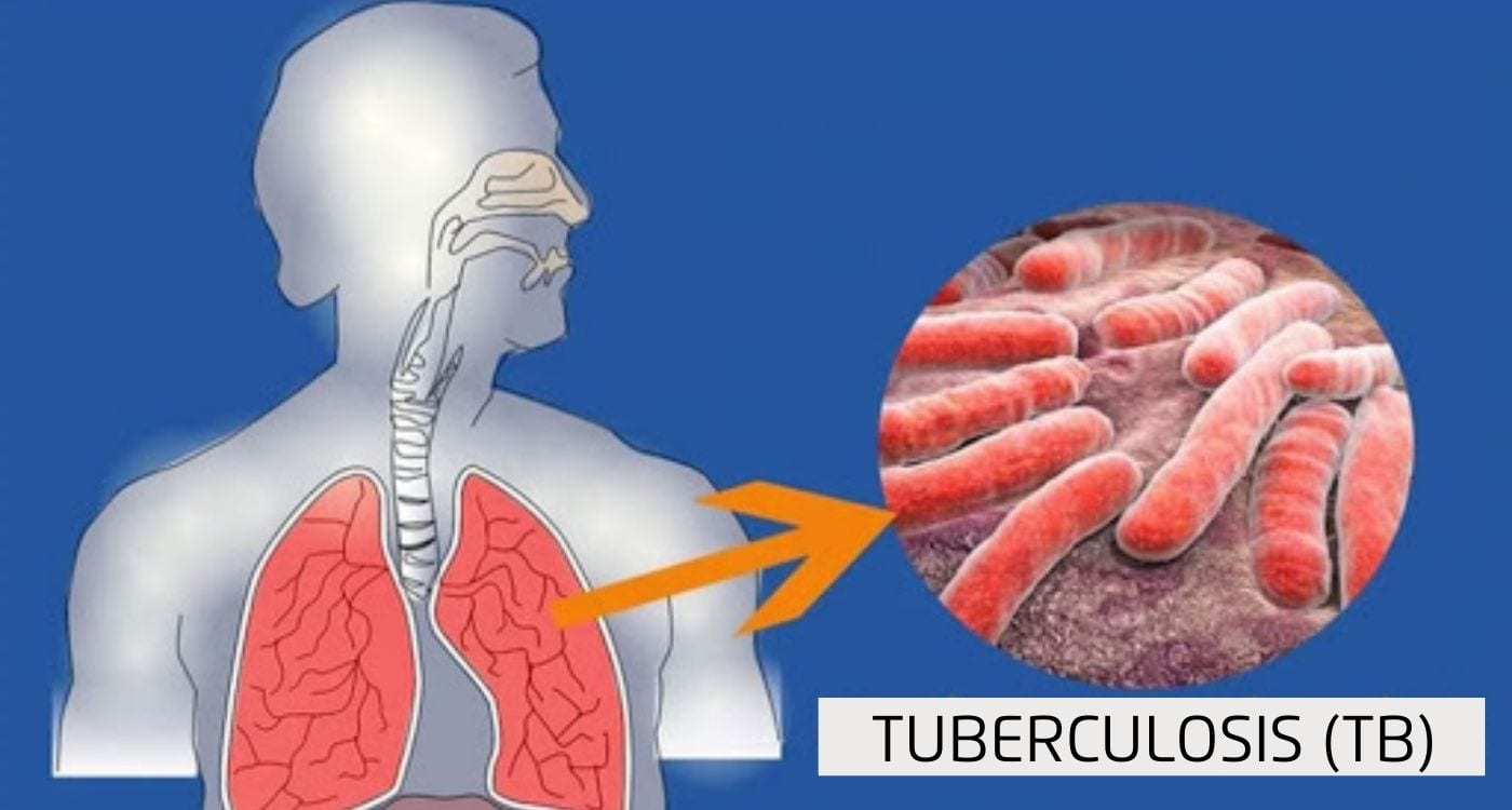 India’s Fight Against Tuberculosis: Progress, Challenges, and the Road Ahead