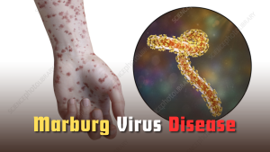 Marburg Virus Disease